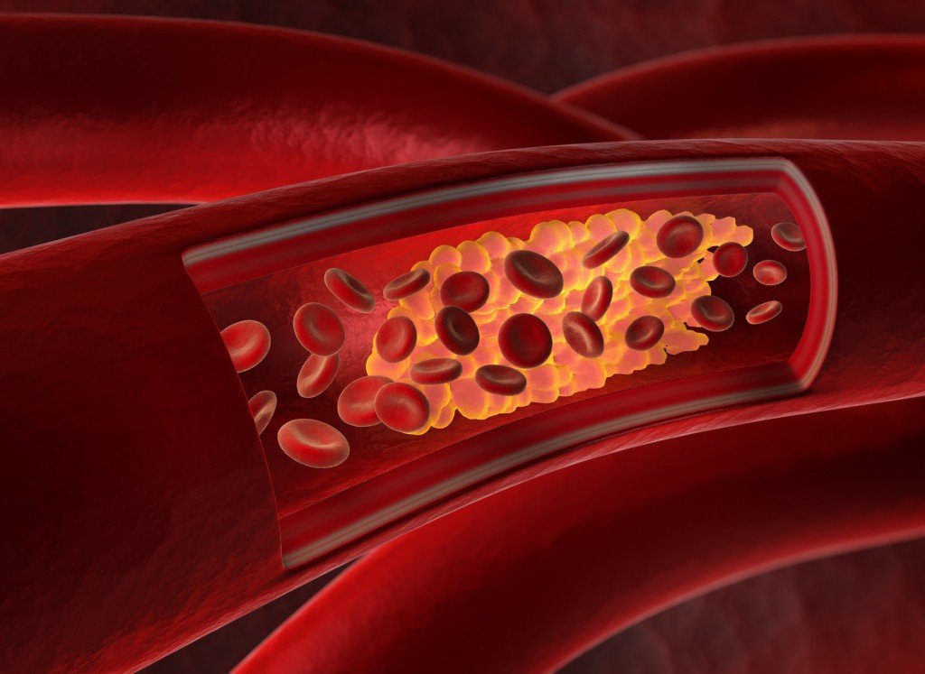 Arterienverkalkung durch Cholesterin