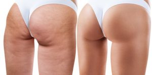 gegen cellulite